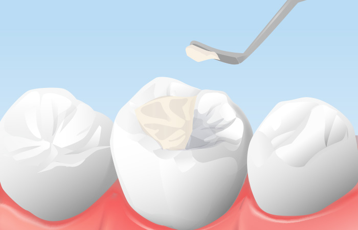 レジンの詰め物(レジン充填)