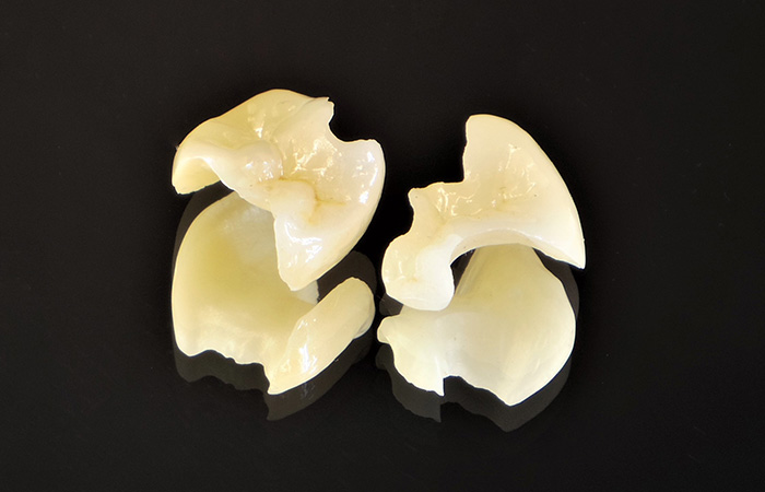 CAD/CAMインレー(ハイブリッドセラミック)