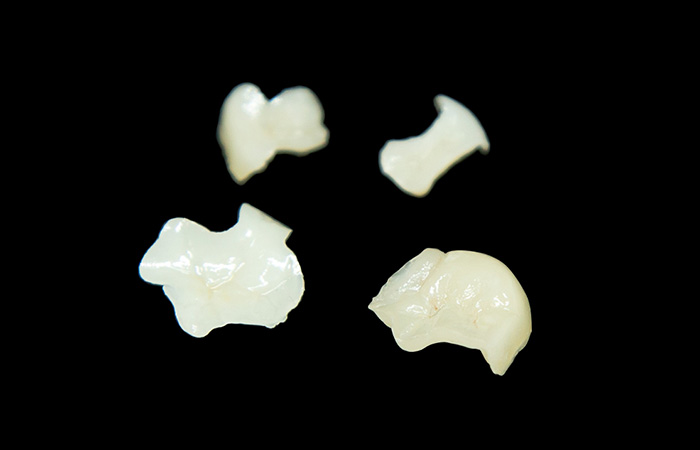 セラミックインレー(e-MAX)