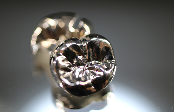 メタルクラウン(銀歯)